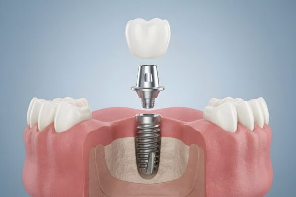 Implant dentar fără os suficient: ce soluții există
