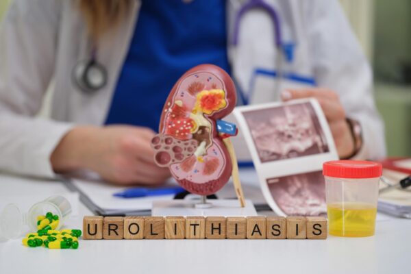 Litotriția extracorporală: când poate fi folosită pentru calculi