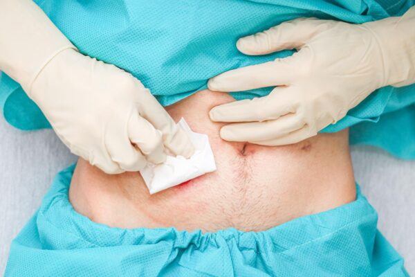 Stomă intestinală nouă: cum te pregătești pentru îngrijirea acasă